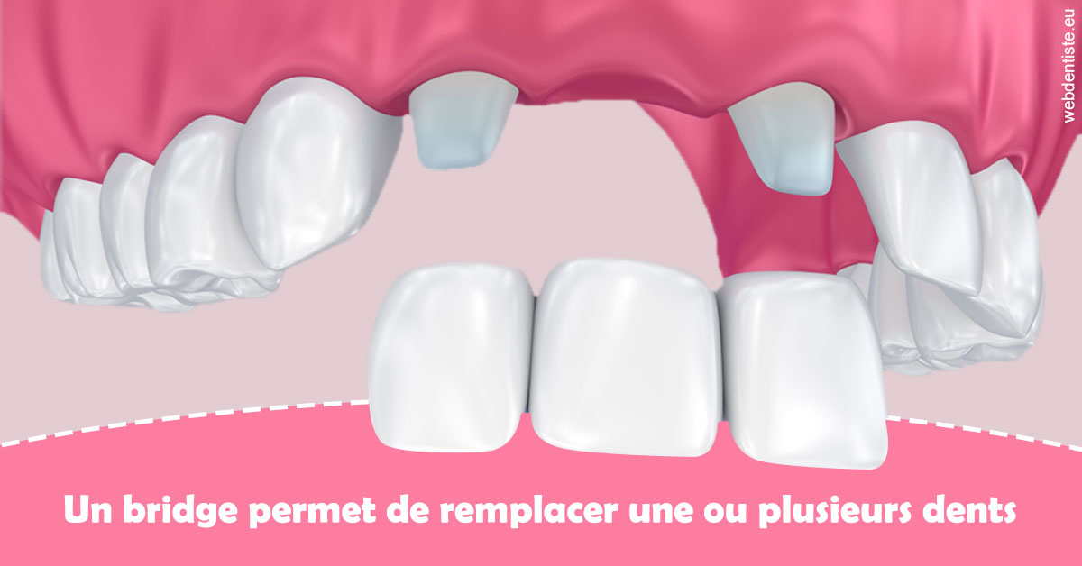 https://dr-meyer-eric.chirurgiens-dentistes.fr/Bridge remplacer dents 2