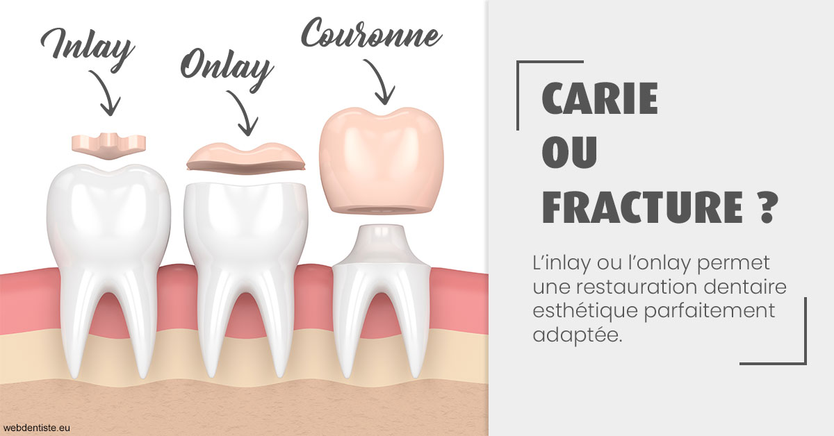 https://dr-meyer-eric.chirurgiens-dentistes.fr/T2 2023 - Carie ou fracture 1