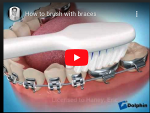 How to brush with braces
