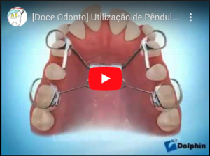 [Doce Odonto] Utilização de Pêndulo em Ortodontia.