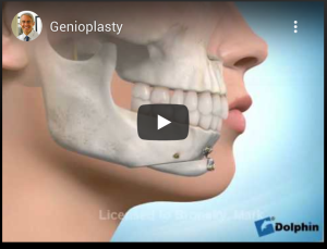 Genioplasty