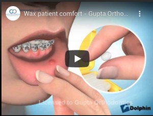 Wax patient comfort - Gupta Orthodontics - Plano Invisalign & Damon Clear Braces