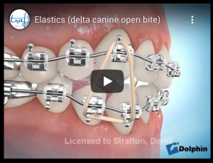Elastics (delta canine open bite)