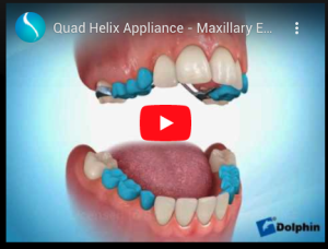 Quad Helix Appliance - Maxillary Expander