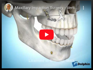 Maxillary Impaction Surgery - Vertical Maxillary Excess